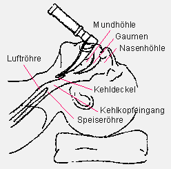 Bild 3: Laryngoskop mit dem abgewinkelten Spatel zum Hochdrücken der Zunge und einer Beleuchtungseinrichtung zum Sichtbarmachen des Kehlkopfs in "Jackson-Position"