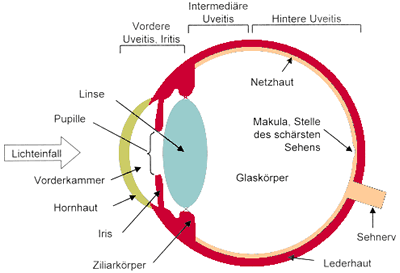 Bild 1: Einteilung der verschiedenen Uveitis-Formen nach dem Ort der Entzndung innerhalb des Auges. Bei der vorderen Uveitis, die hufig im Rahmen eines Morbus Bechterew auftritt, liegt der Entzndungsschwerpunkt in der Vorderkammer, der Iris und dem dahinter liegenden Ziliarkrper. Oft ist auch die Rckflche der Hornhaut mit beteiligt. Bei schwer verlaufenden Entzndungen finden sich Trbungen auch im vorderen Teil des Glaskrpers. Gelegentlich ist auch die Netzhaut geschwollen (Netzhautdem). Der Kasten um die Makula verweist auf die Region, die im Bild 3 dargestellt ist.