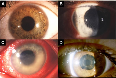 Bild 2: Befunde bei einer Iritis
A) Normaler vorderer Augenabschnitt.
B) Bindehautentzndung (1) und helle, entzndliche Beschlge auf der Hornhautrckflche (2).
C) Fibrin (entzndliche Proteinausschwitzung) fllt ca. 2/3 der Vorderkammer aus (3). Die unteren 2/3 der Iris sind verwaschen und unscharf zu sehen, whrend die oberen Anteile noch normal aussehen.
D) Verklebungen der Regenbogenhaut mit der Linse (hintere Synechien). In der Mitte der Pupille finden sich kreisfrmig Ablagerungen der Iris auf der Linsenvorderflche. Unten ist die Pupille nicht mehr rund, und man sieht eine neue Verklebung (4).