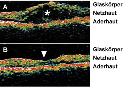Bild 3: ZystoidesMakula-dem
Bei einer Iritis kann es zu einer Schwellung der Netzhaut kommen, bevorzugt in der Makula, der Stelle des schrfsten Sehens. Dargestellt ist ein Schnitt durch die Netzhaut entsprechend dem im Bild 1 markierten Abschnitt. hnlich wie bei einer Ultraschalluntersuchung wurde hier, allerdings mit einem Laser, die Netzhautdicke sichtbar gemacht. Diese Untersuchung ist fr den Patienten schmerzlos. 
A) In der Netzhaut eines Iritis-Patienten hat sich Flssigkeit (*) eingelagert, die zu einer Sehverschlechterung fhrt.
B) Als Folge der Therapie ist die demflssigkeit abgeflossen. Es zeigt sich wieder die normale Abflachung der Netzhaut im Bereich der Makula (Dreieck). Die Sehschrfe ist wieder angestiegen.