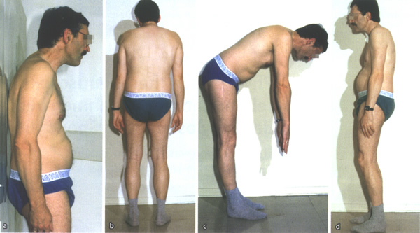 Bild 1: Statische Vernderungen bei fortgeschrittener Spondylitis ankylosans. (a) Kopf-Wand-Abstand bei eingesteifter Halswirbelsule. (b) Angedeutete Brustwirbelsulen-Kyphose und Schulterhochstand rechts. (c) Finger-Boden-Abstand bei maximaler Rumpfbeugung und Abflachung der Lendenwirbelsulen-Lordose (Bgelbrettrcken). (d) Hftbeugestellung und Ausbildung eines Fuballbauchs bei Versteifung der Rippen-Wirbel- und Rippen-Brustbein-Gelenke, berstreckung der Halswirbelsule, Brustwirbelsulen-Kyphose, Abflachung der Lendenwirbelsule.