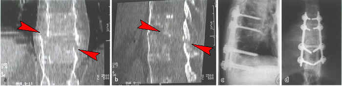 Bild 1: a) Im Computertomogramm sichtbarer seitlicher Versatz der Wirbelsule infolge einer Fraktur bei Morbus Bechterew. b) Das seitliche Computertomogramm zeigt die Ausdehnung der Fraktur (Pfeile) bis zum Wirbelbogen (rechter Pfeil). c) Seitliche und d) frontale Rntgenaufnahme nach der operativen Stabilisierung durch mit den Wirbelkrpern verschraubte Metallstbe.
