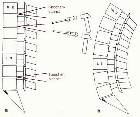 Bild 1: Schematische Darstellung des Korrekturverfahrens mit mehreren Knochenschnitten (a) zur Wiederherstellung einer harmonischen Lordose (Krmmung nach hinten) der Lendenwirbelsule (b).
Th11 = 11. Brustwirbel, L3 = 3. Lendenwirbel.Nach H. Bhm, H.-J. Hehne und K. Zielke, Bechterew-Brief Nr. 57 S. 318).